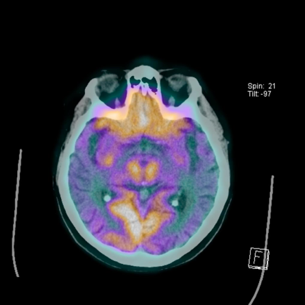 Alzheimer’s Disease Combined PET/CT Scan