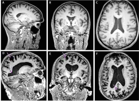 Alzheimer’s Disease MRI Scans