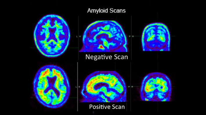 Alzheimer’s Disease PET/MRI Scan